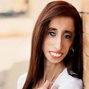 Bilder Lizzie Velasquez