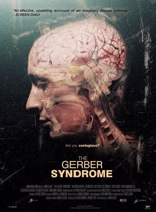  The Gerber Syndrome